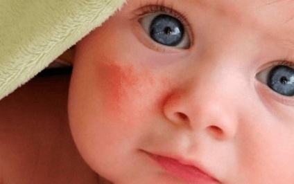 Kitörések a hátán, a gyermek bőrének okoz kiütések akne