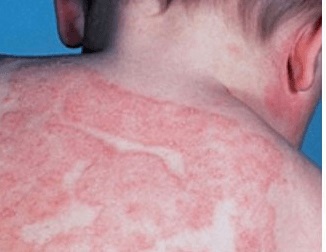 Erupțiile pe spate, pielea la copil, provoacă cosuri de acnee