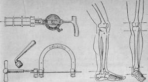 Extensie - traumatolog ro