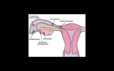 În ce cazuri este laparoscopia ovarelor