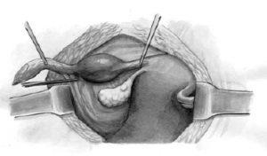 Ectopic sarcina în ce termen tubul izbucni, așa cum se întâmplă