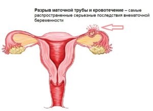 Méhen kívüli terhesség, milyen távon csőtörés, mint ez történik