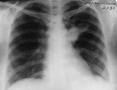 Cronică pneumonie nespecifică