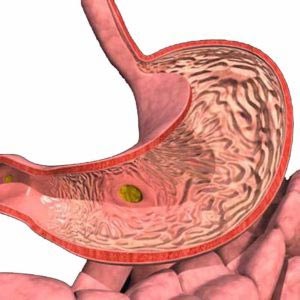 Tratamentul gastroduodenitelor cronice, cauze, simptome