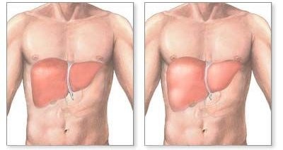 Simptomele bolii hepatice, diagnosticul și tratamentul ficatului