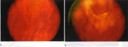 Boli ale periferiei retinei au rupt retea