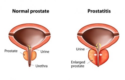 În spatele înțelepciunii poporului tratamentul prostatitei cu remediile populare