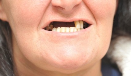 Femeia și-a pierdut dinții după albirea nereușită - portal medical - arbore al vieții