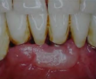 Valoarea gingiilor keratinizate