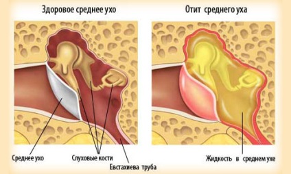 Csengetés és a zaj a fülben (tinnitus) után otitis