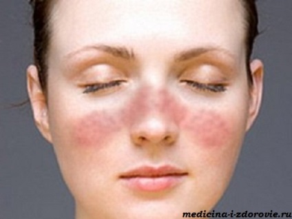 Alergii la produsele cosmetice pe ochi, cauze, simptome, tratament