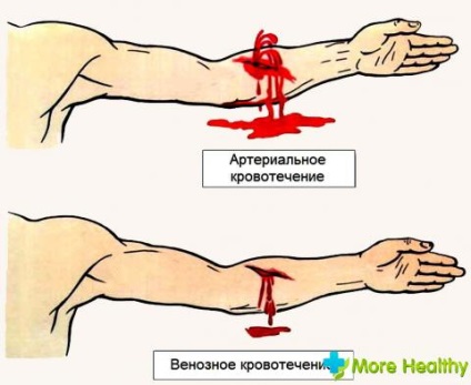 Sângerarea arterială ca prim ajutor