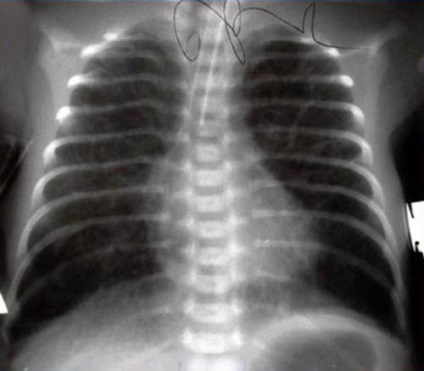 Simptome de displazie bronhopulmonară, diagnostic, prognostic