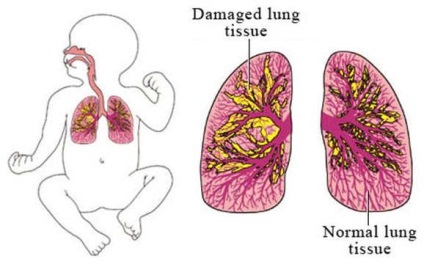 Simptome de displazie bronhopulmonară, diagnostic, prognostic