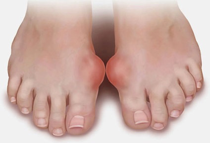 Bursita simptome picioare, tipuri, moduri de tratament