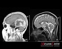 Craniocerebral traumatism, contuzie, leziuni cerebrale