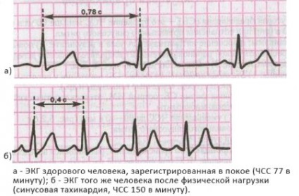 Ce este simptomele și tratamentul inimii tahicardiei sinusale?