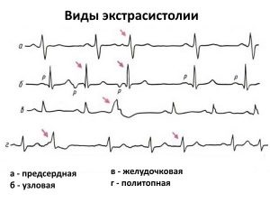 Simptome extrasistole, motive de tratament, diagnostic