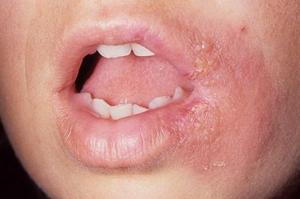 Herpes în gura unui țânțar pentru copii