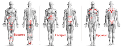 Hirudotherapy point leech sucking (scheme), versiune mobilă