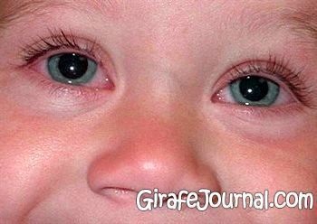 Eye gyermekkori fertőzések