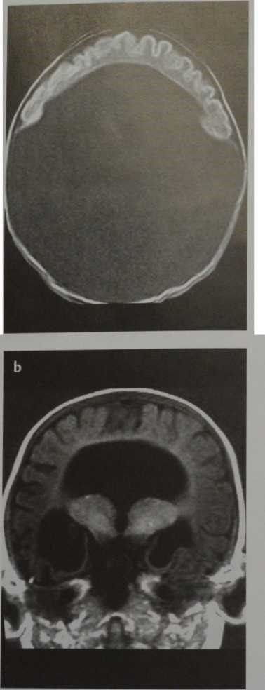 Goloprozenzefalija - un defect al dezvoltării unui creier