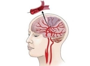 Accident vascular cerebral de tratament cerebral, simptome și de prevenire la adulți și copii