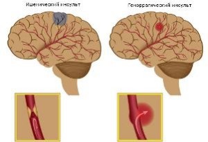 agyi stroke kezelés és a tünetek megelőzésében felnőttek és gyermekek