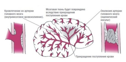 Simptome de accident vascular cerebral ischemic, cauze ale bolii și prognostic