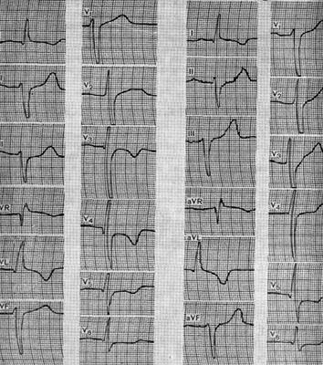 Schimbări în ecg la esofagul hernial al diafragmei - modificări ale ecg pentru unele boli,