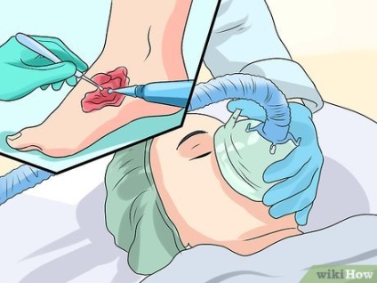 Cum să tratăți gangrena
