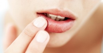 Hogyan akne kezelésére ajkán típusú kiütések és hogyan megszabadulni tőlük