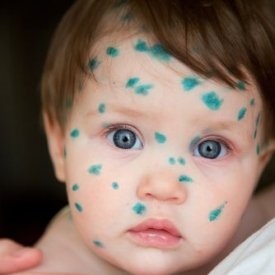 Cum se trateaza varicela la copiii cu simptome si tratament (foto)