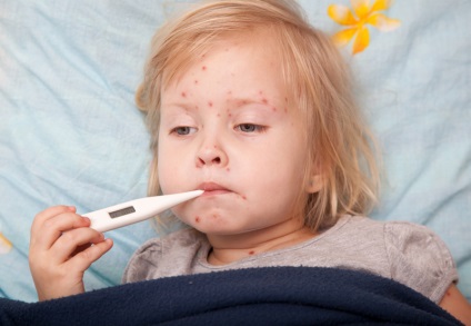Cum se trateaza varicela la copiii cu simptome si metode de tratament (foto)
