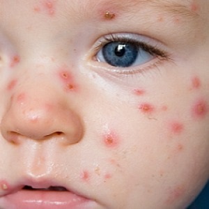 Cum începe varicela la copii, primele semne, fotografii, tratament