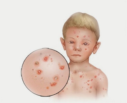 Cum începe varicela la copii, primele semne, fotografii, tratament