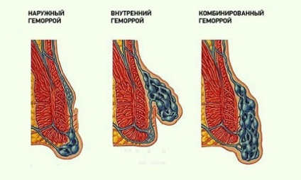 Cum de a determina hemoroizii sau nu