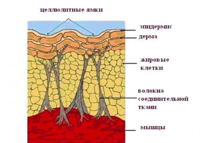 Ahogy eltávolítani cellulit keresztül ultrahangos kezelés St. Petersburg, abriell