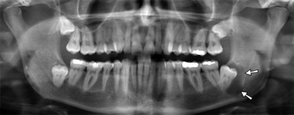 Cyst dinte, costul de a elimina chisturi de la laser, ceea ce este un chist pe dinte, simptome, tratament foto,
