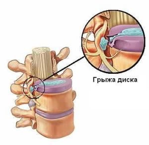 Corset cu hernie lombare tipuri de dispozitive și reguli de selecție