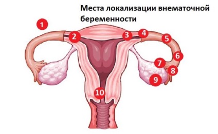 Laparoscopia pentru sarcina ectopică pentru care este necesară o intervenție chirurgicală