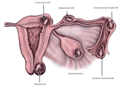 Laparoscopia pentru sarcina ectopică pentru care este necesară o intervenție chirurgicală