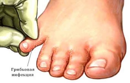 Tratamentul micozelor piciorului cu remedii folclorice la domiciliu