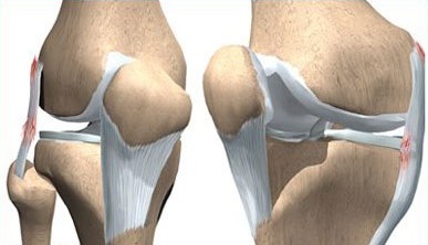 Tratamentul rupturilor și leziunilor ligamentelor articulației genunchiului cu ajutorul operațiilor artroscopice
