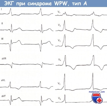 Mecanismele sindromului Wolff-Parkinson