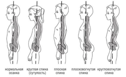 Încălcarea posturii la copiii de vârstă școlară, diagnosticul de scolioză