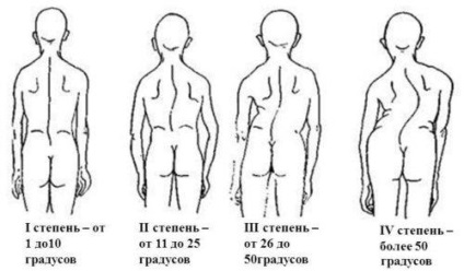 Încălcarea posturii la copiii de vârstă școlară, diagnosticul de scolioză