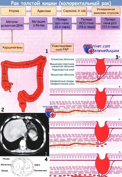 Ereditar non-polipoză cancer de colon (NNPT, sindrom Lynch i