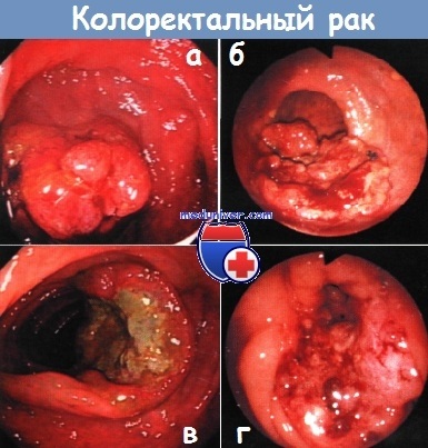 Ereditar non-polipoză cancer de colon (NNPT, sindrom Lynch i