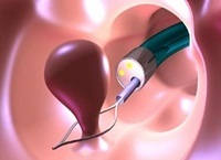Operația de îndepărtare a polipului în uter - principalele nuanțe